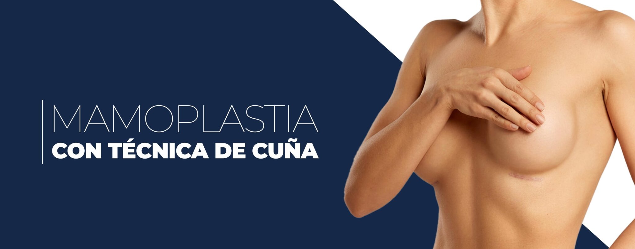 Mamoplastia